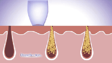 REMOVEDOR DE PUNTOS NEGROS-UltraClean XN